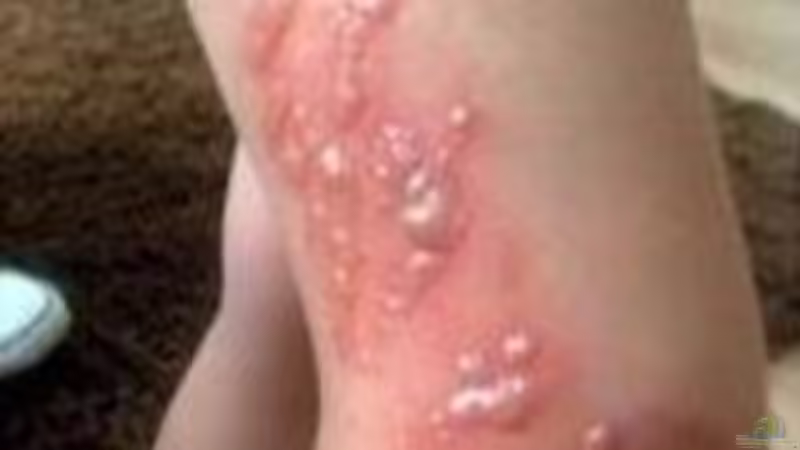 Riesen-Bärenklau: So soll die invasive Pflanze bekämpft werden